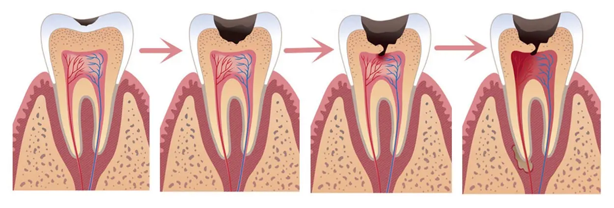 Dental Caries Definition and Its Comprehensive Guide
