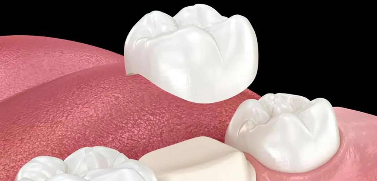 Dentist preparing a tooth for a dental crown