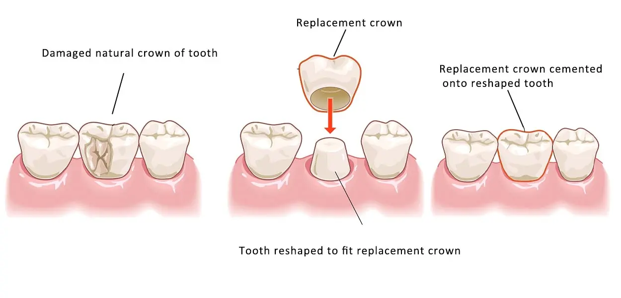 What is a Dental Crown