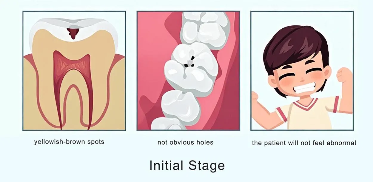 dental caries initial stage