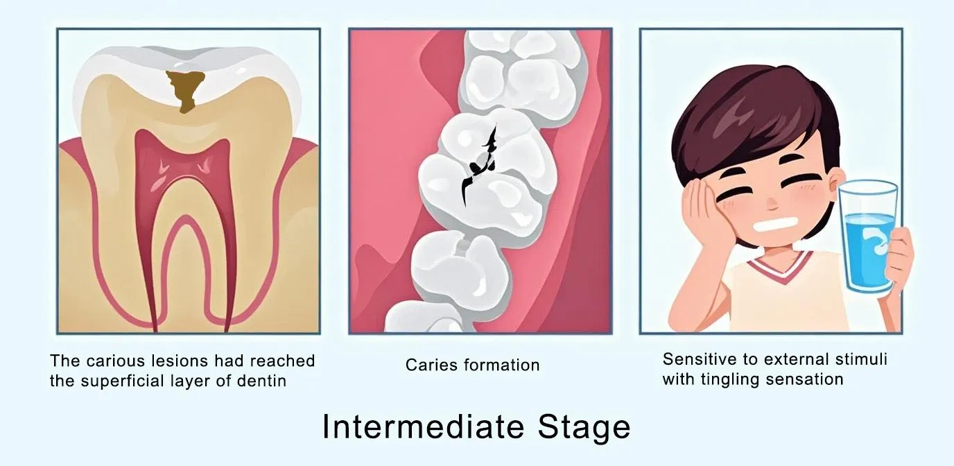 dental caries intermediate stage