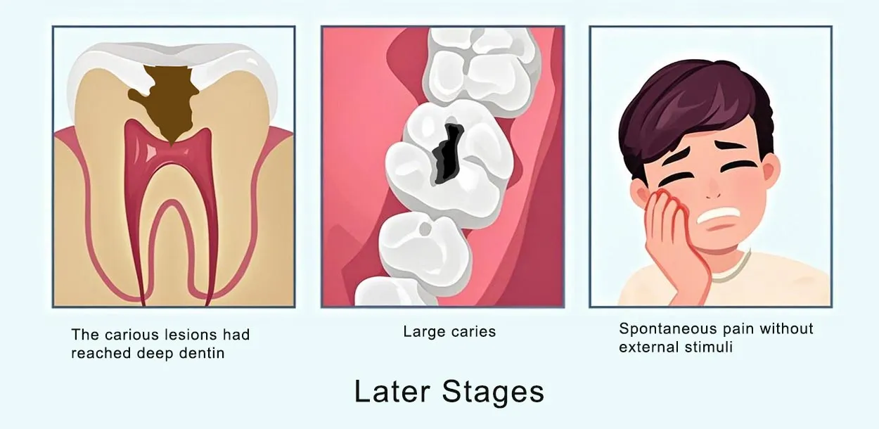dental caries later stages
