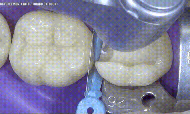 Cavity Preparation