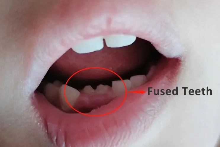 Fused Teeth