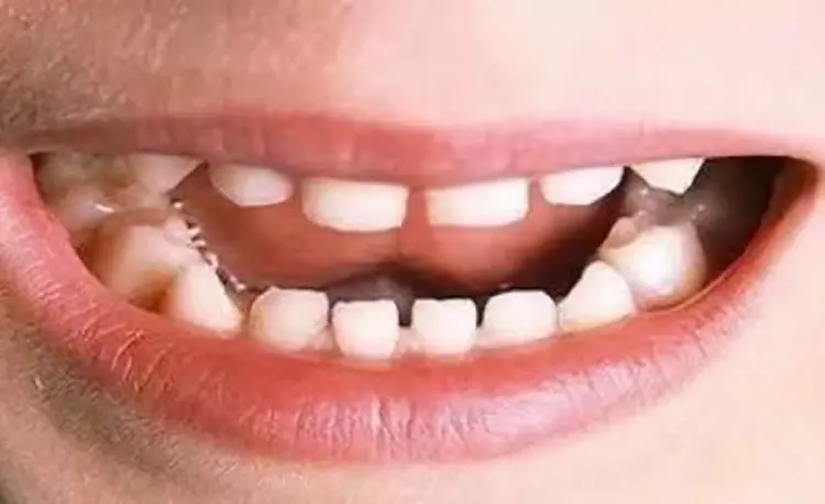 Physiological gaps after eruption of milk teeth