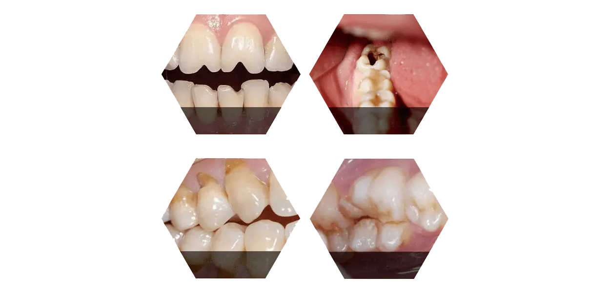 When do I need dental fillings