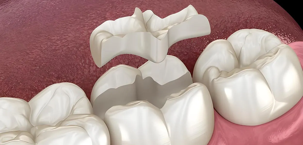 porcelain inlay implantation - dental fillings