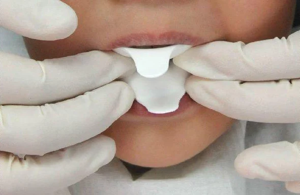フッ化物イオンを連続的に放出するフッ素化フォームトレイ