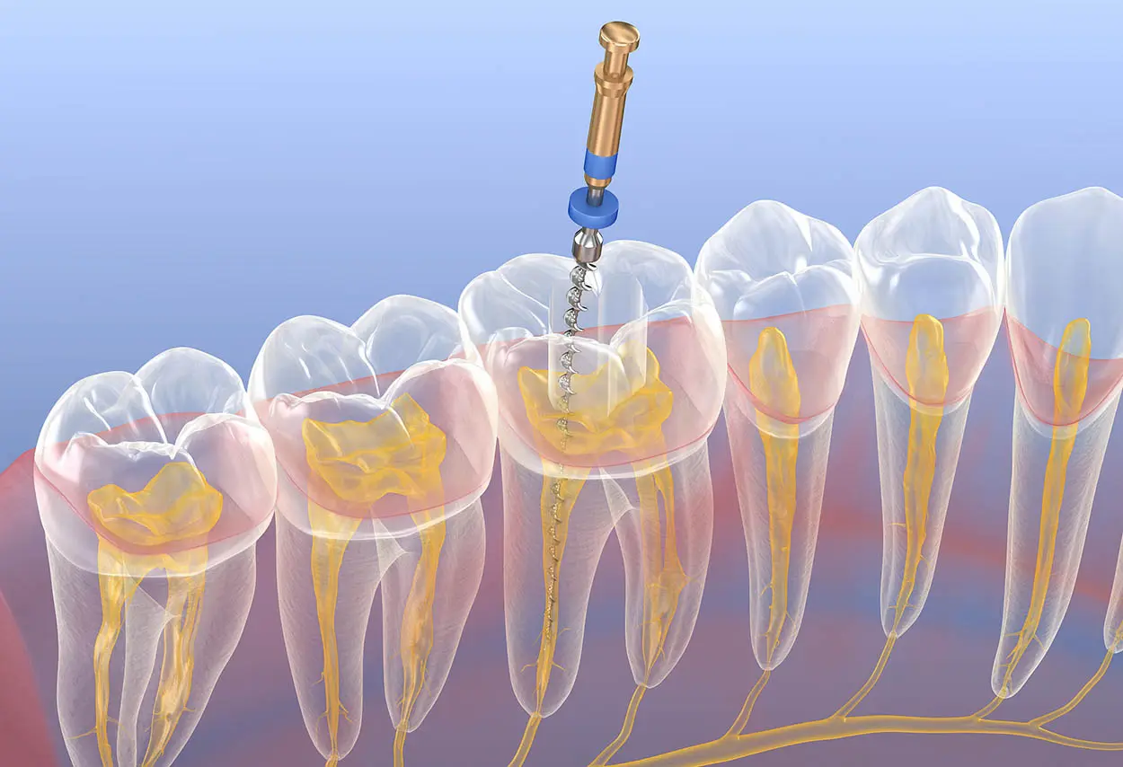 Root Canal Treatment