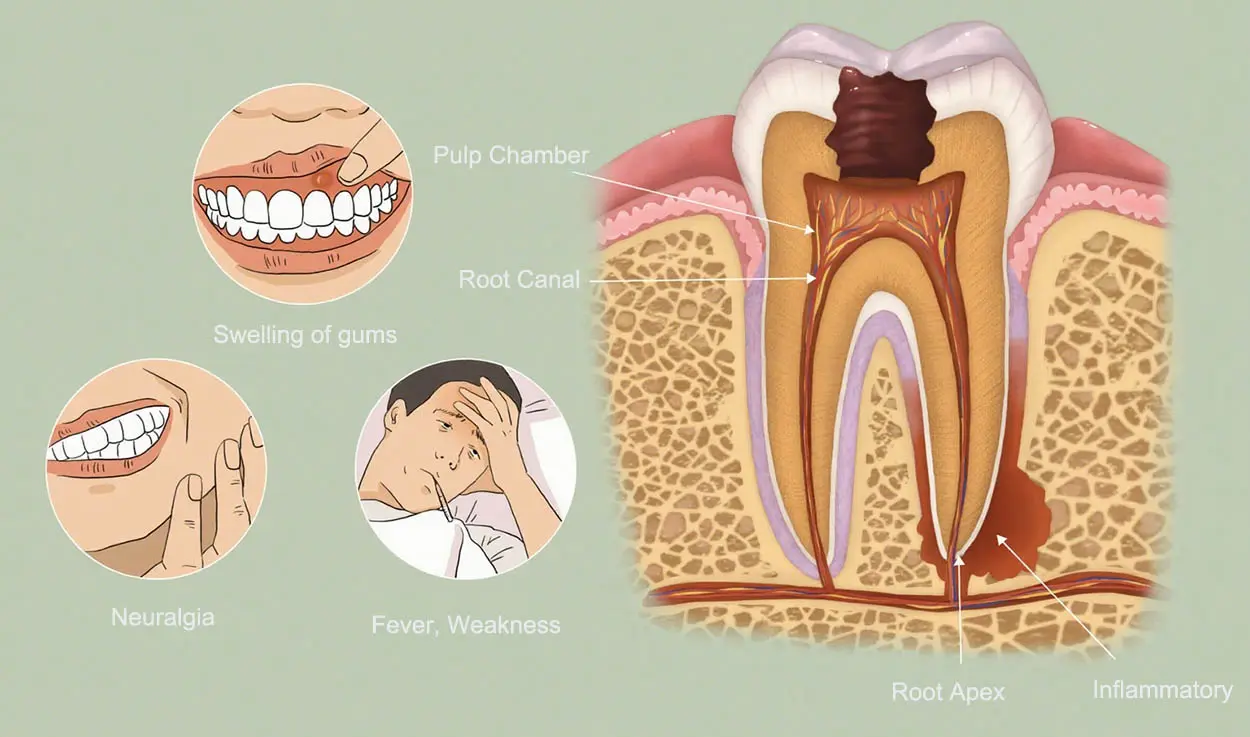 periapical infection
