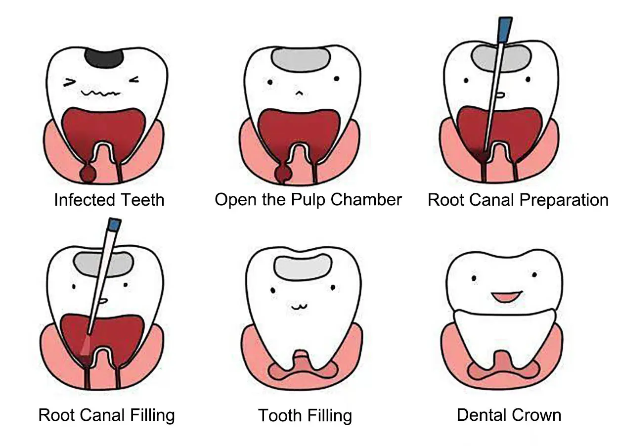 process of root canal treatment