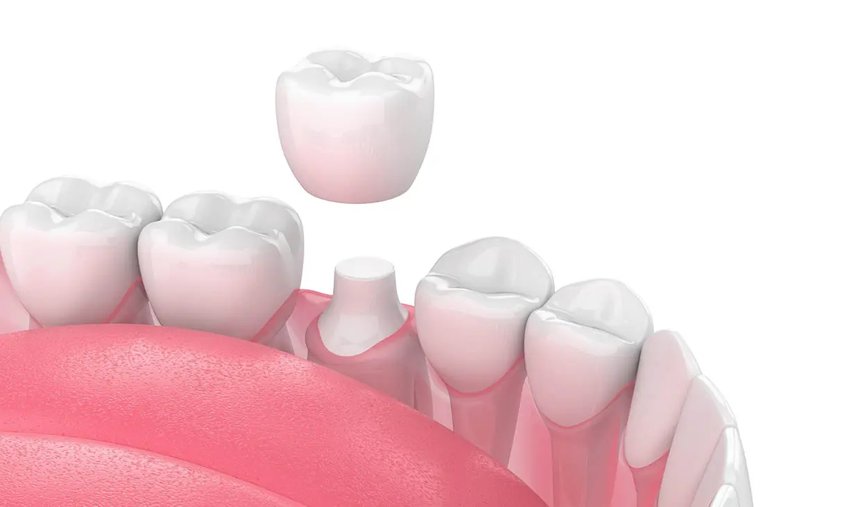 wear a crown after root canal treatment