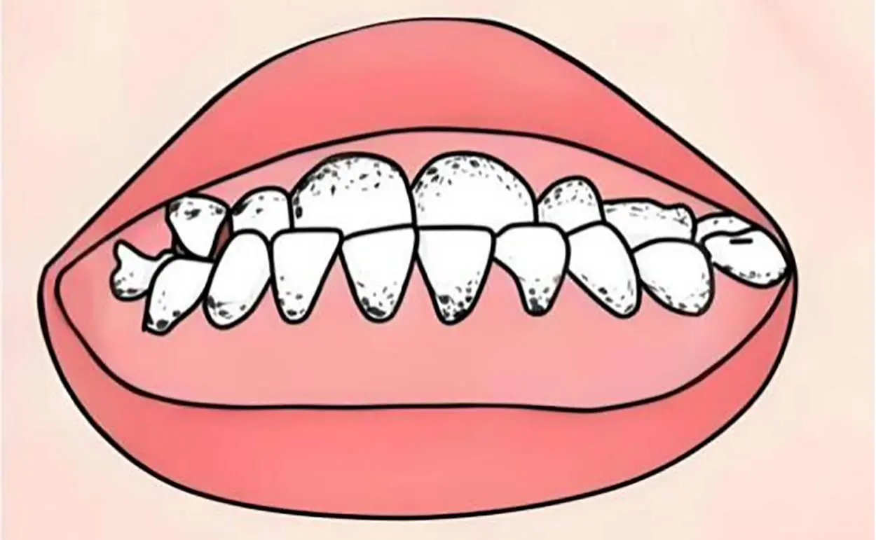underbite